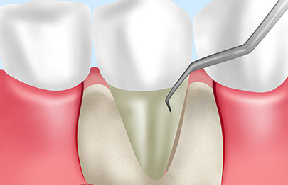 進行した歯周病は歯茎を開くフラップ手術